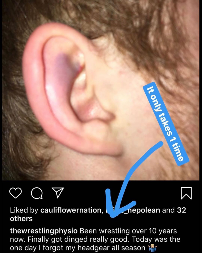 why headgear isn't enough to prevent cauliflower ear